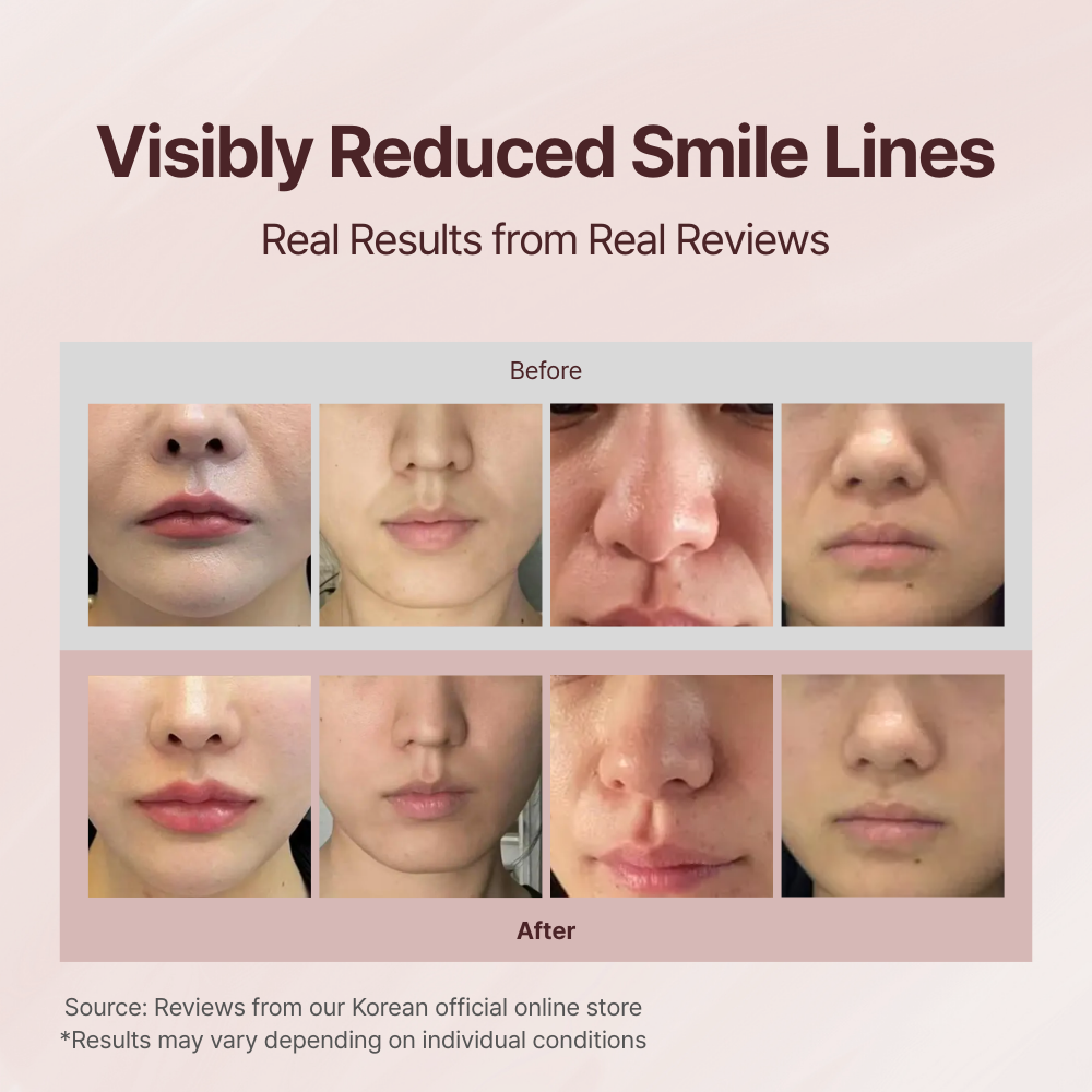 Averin Smile Line Kit