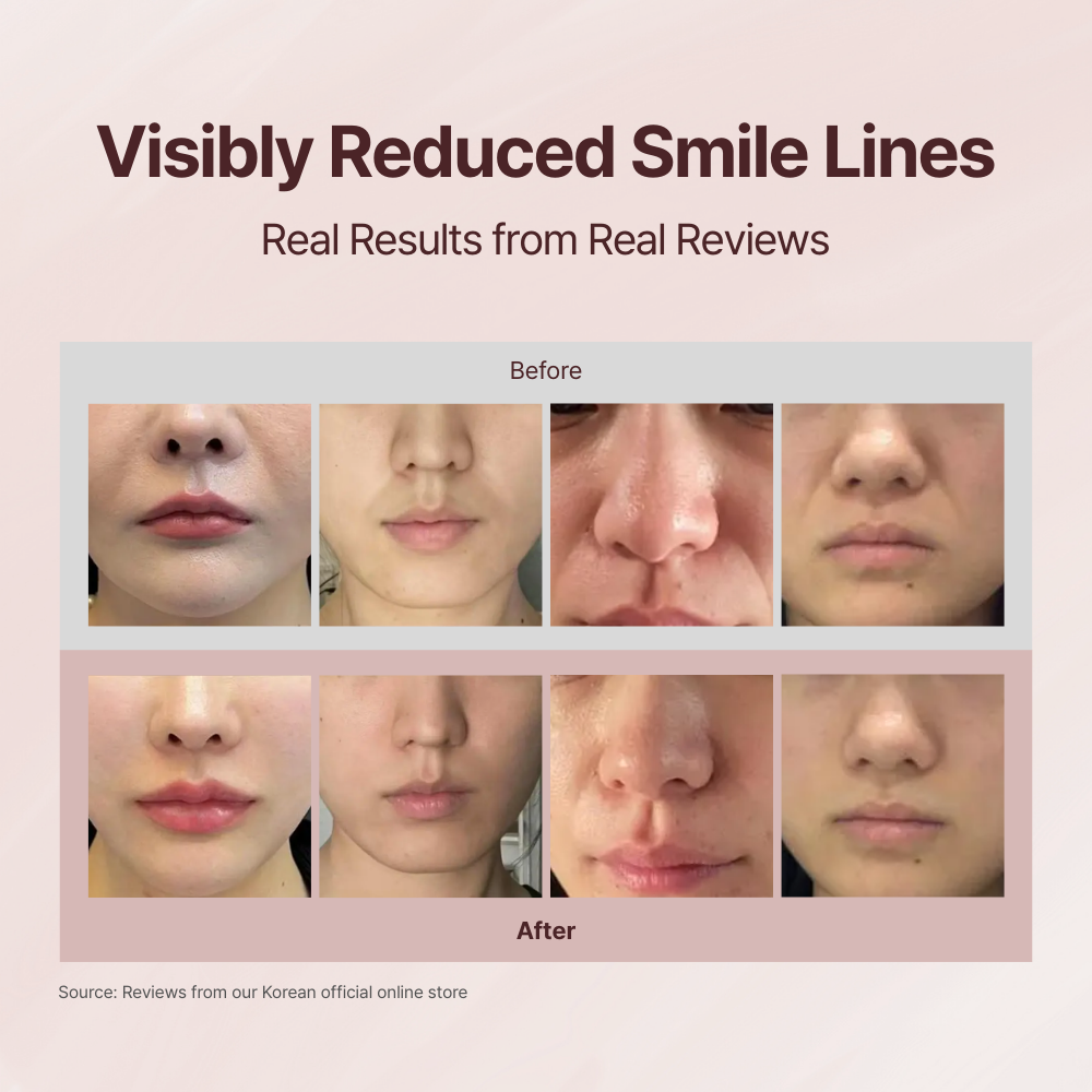 Averin Smile Line Kit